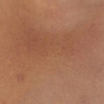 Tattoo Allergy: 7 Proven Signs You’re Ignoring a Painful Reaction