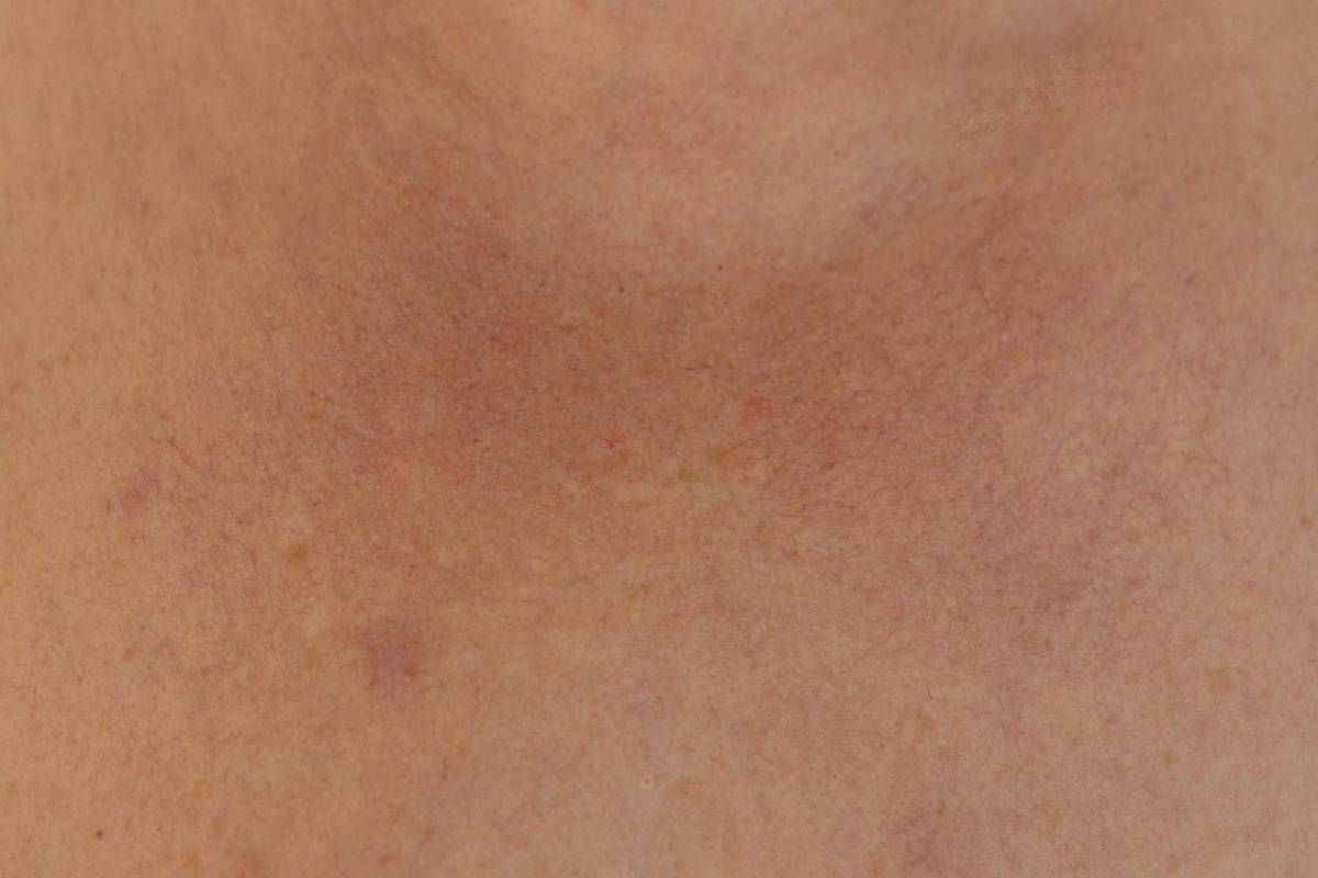 Tattoo Allergy: 7 Proven Signs You’re Ignoring a Painful Reaction